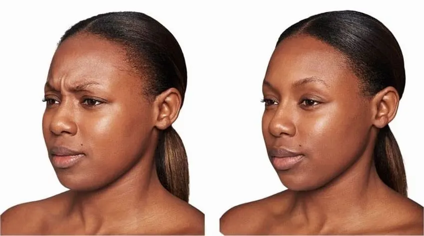 Before and after neurotoxin treatment result 4 at Healthy Enhancements in Wellington, FL