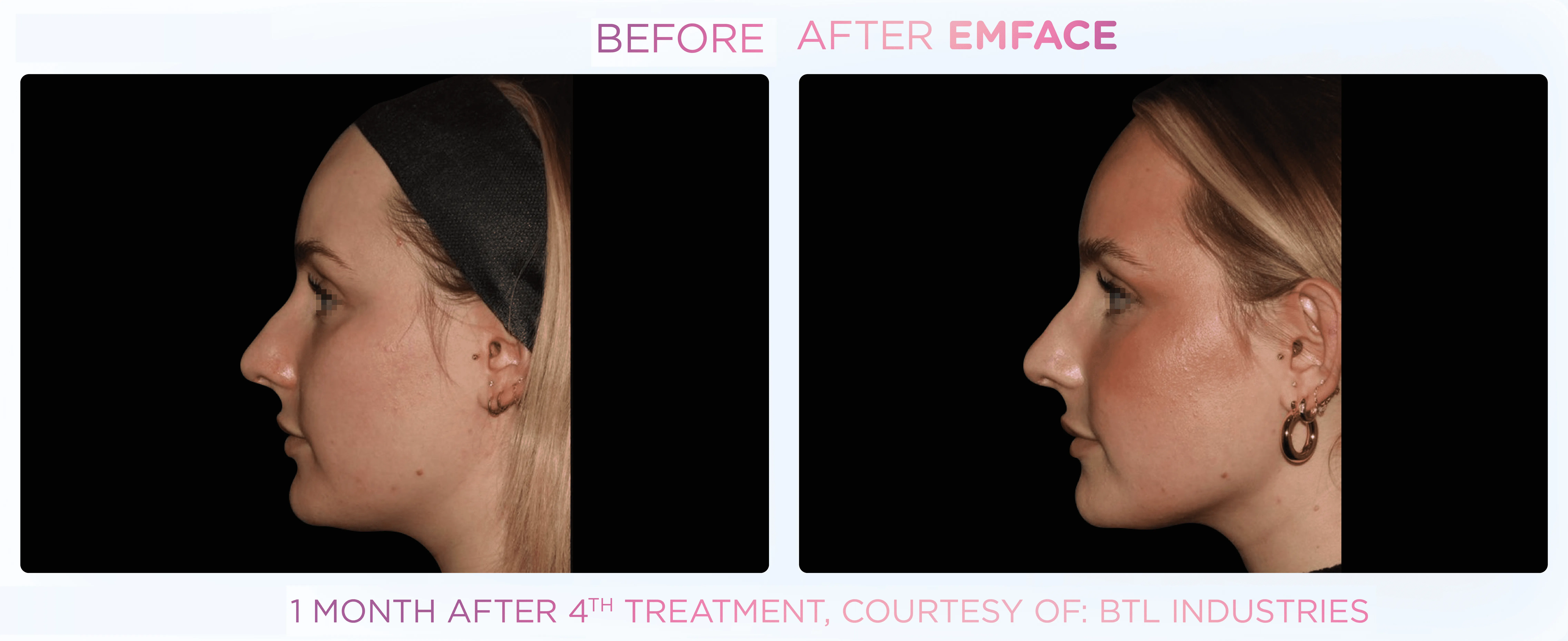 Before and after Emface treatment result 2 at Healthy Enhancements in Wellington, FL
