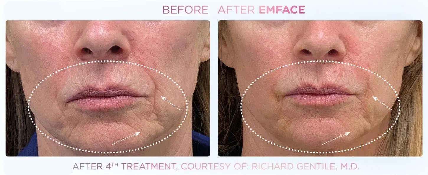 Before and after Emface treatment result 1 at Healthy Enhancements in Wellington, FL