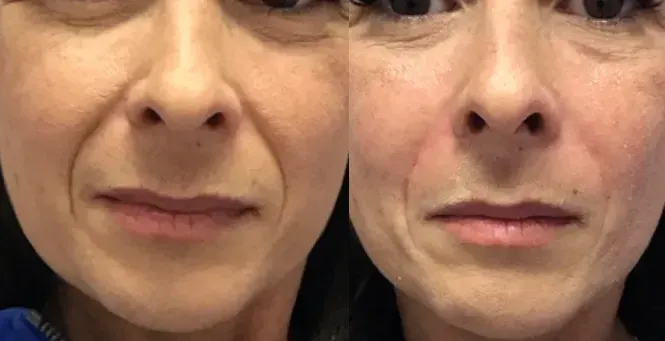 Before and after dermal filler treatment result 2 at Healthy Enhancements in Wellington, FL