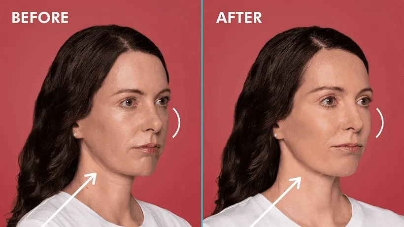 Before and after dermal filler treatment result 1 at Healthy Enhancements in Wellington, FL
