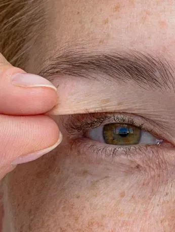 Close-up of droopy upper eyelids and hooded eyes at Healthy Enhancements Wellington