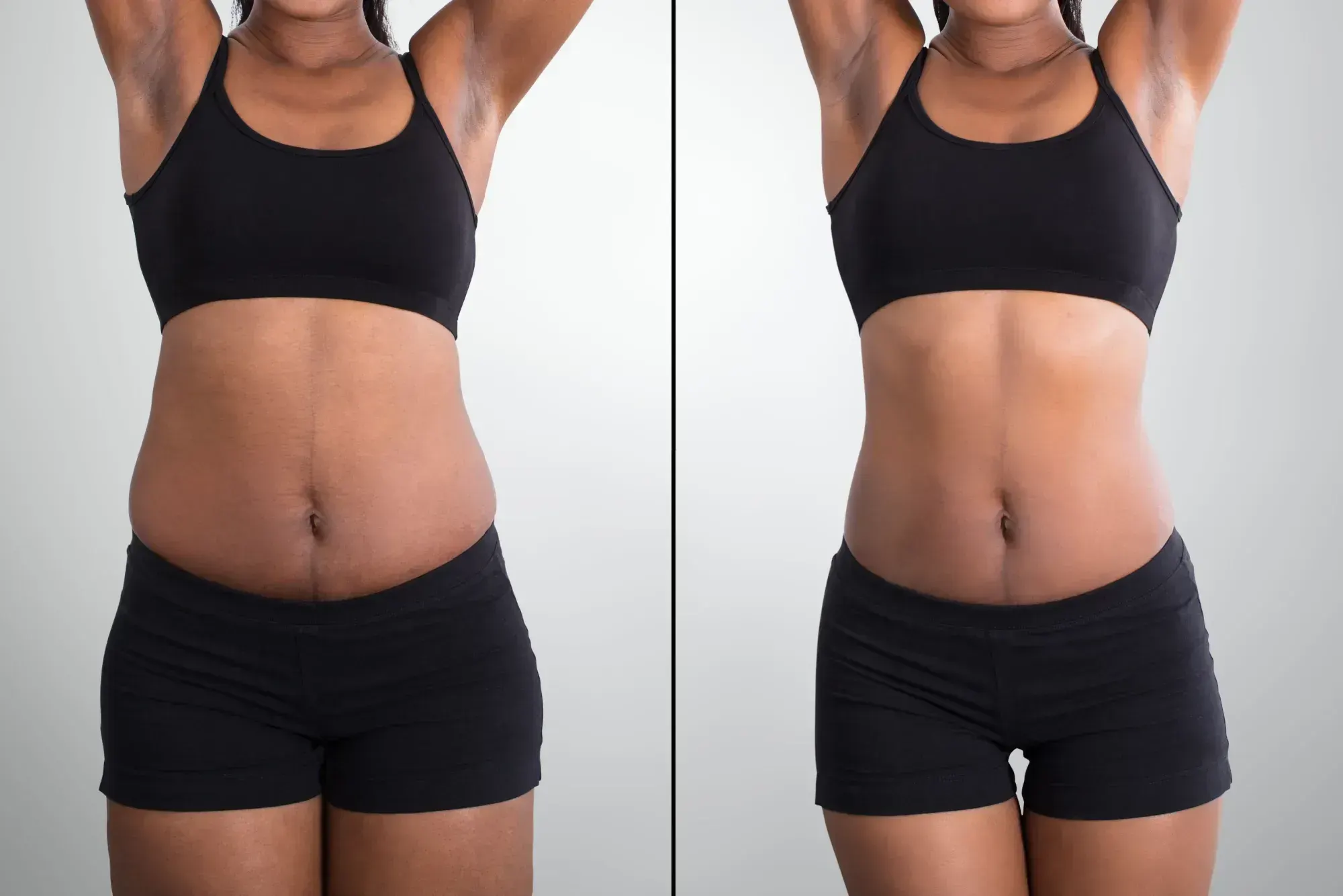 Before and after Weight Loss treatment result 2 at Healthy Enhancements in Wellington, FL