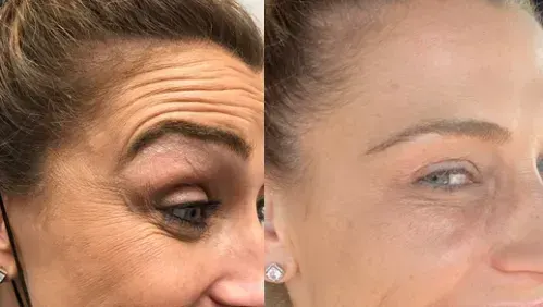 Before and after neurotoxin treatment result 5 at Healthy Enhancements in Wellington, FL