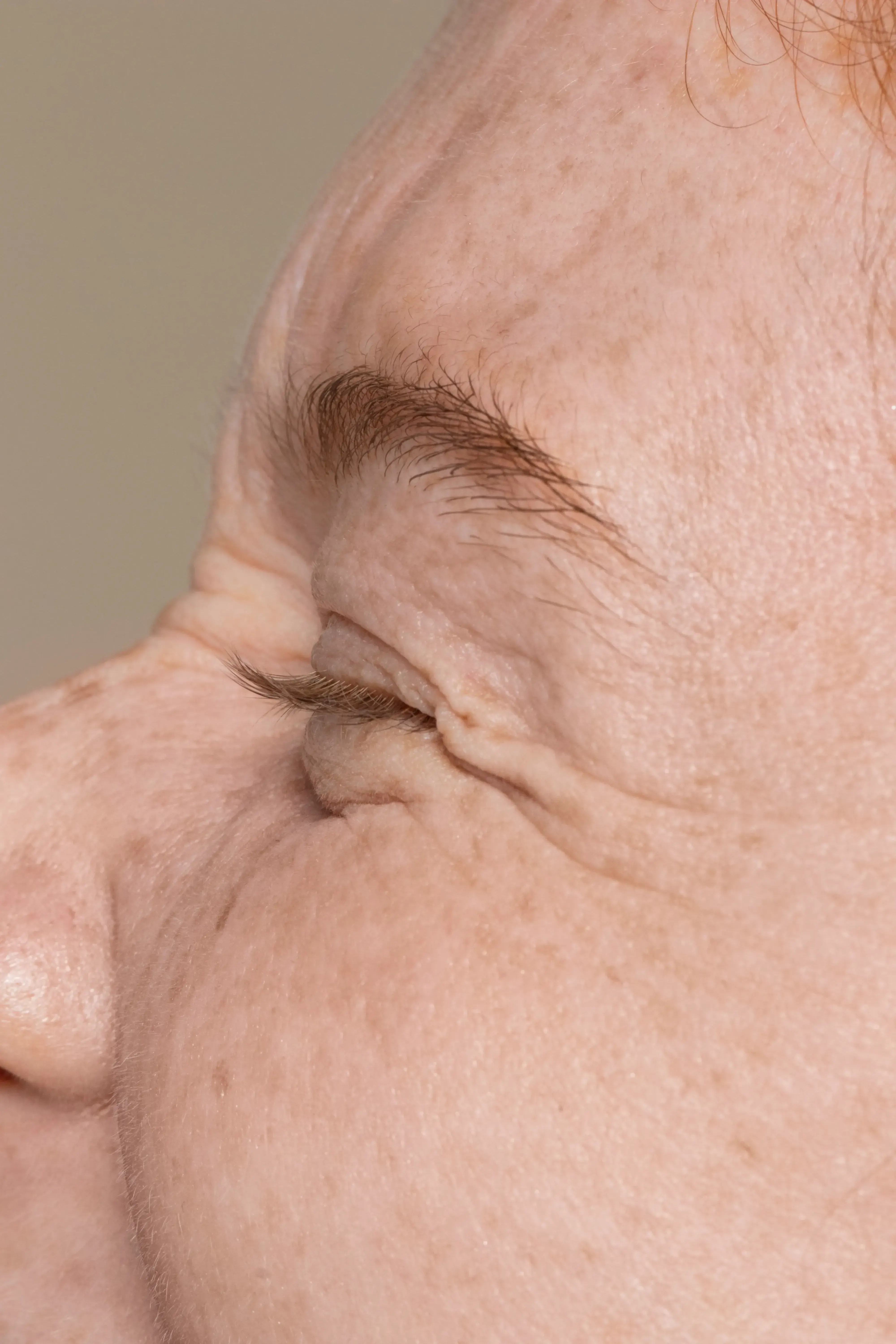 Illustration of the orbicularis oculi muscle creating crow's feet at Healthy Enhancements Wellington FL