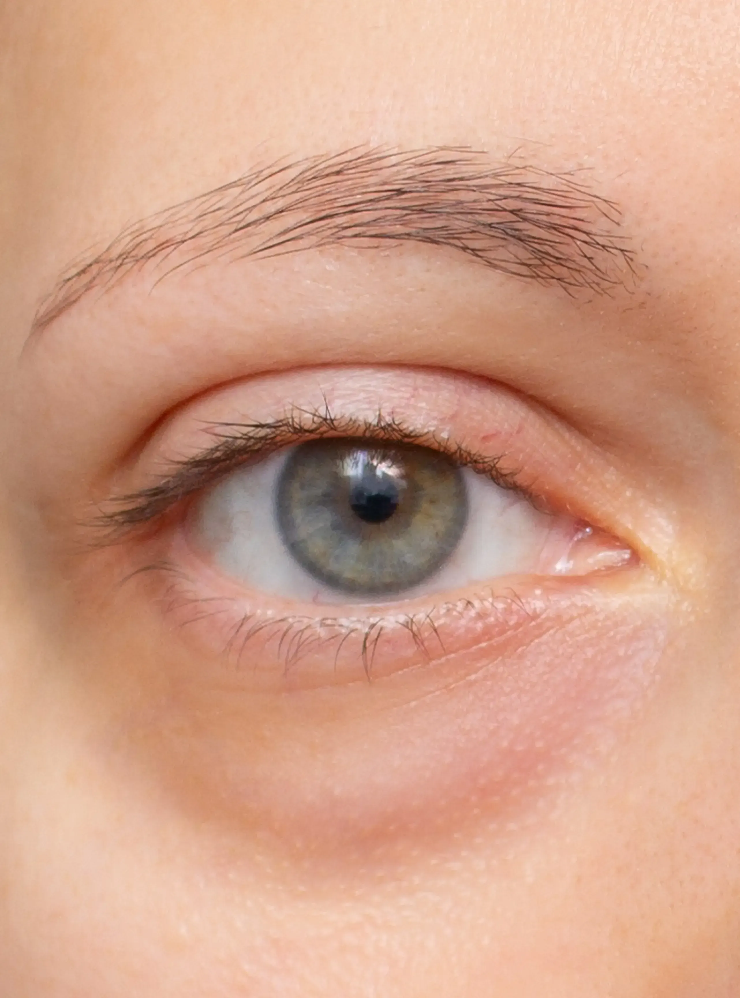 Close-up of tear trough hollowing addressed with under eye filler at Healthy Enhancements