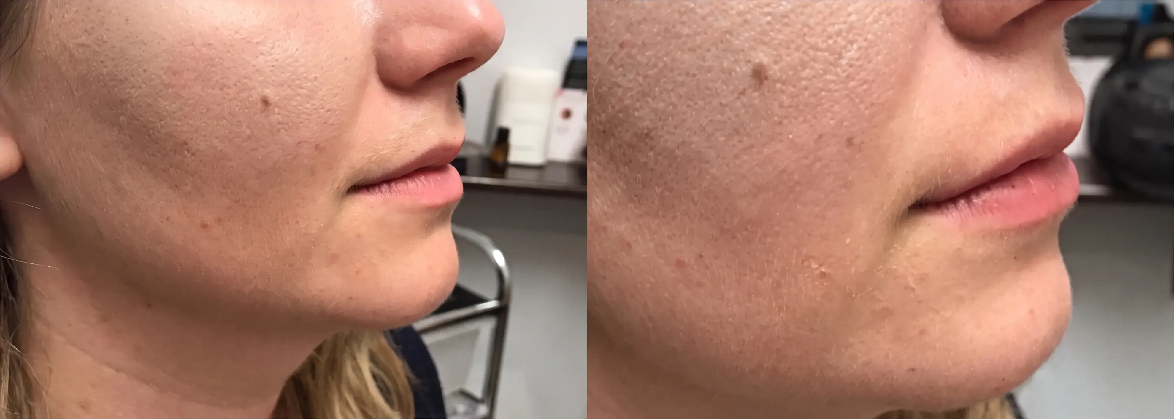 Before and after dermal filler treatment result 12 at Healthy Enhancements in Wellington, FL