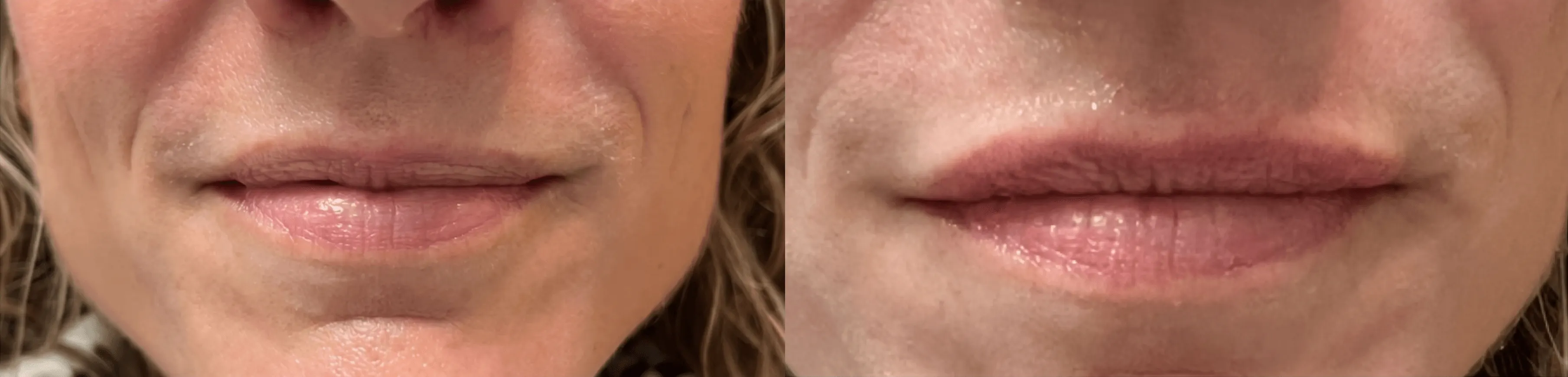 Before and after dermal filler treatment result 3 at Healthy Enhancements in Wellington, FL