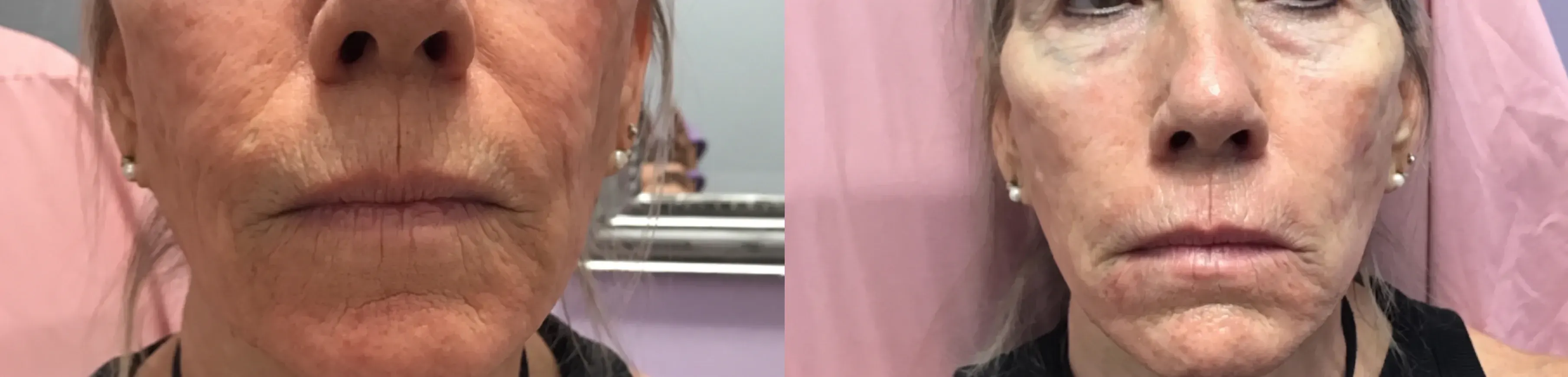 Before and after dermal filler treatment result 4 at Healthy Enhancements in Wellington, FL