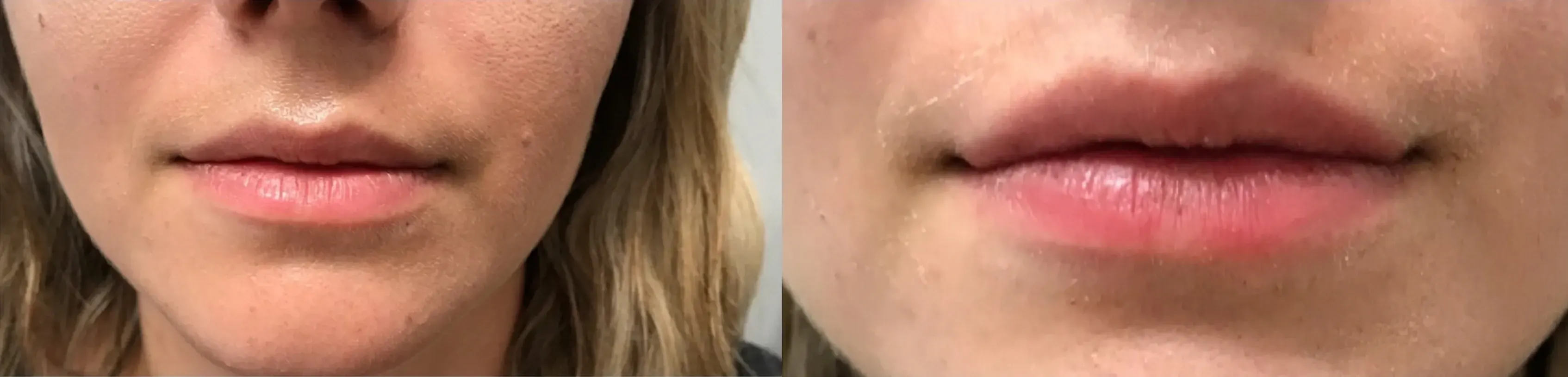 Before and after dermal filler treatment result 5 at Healthy Enhancements in Wellington, FL