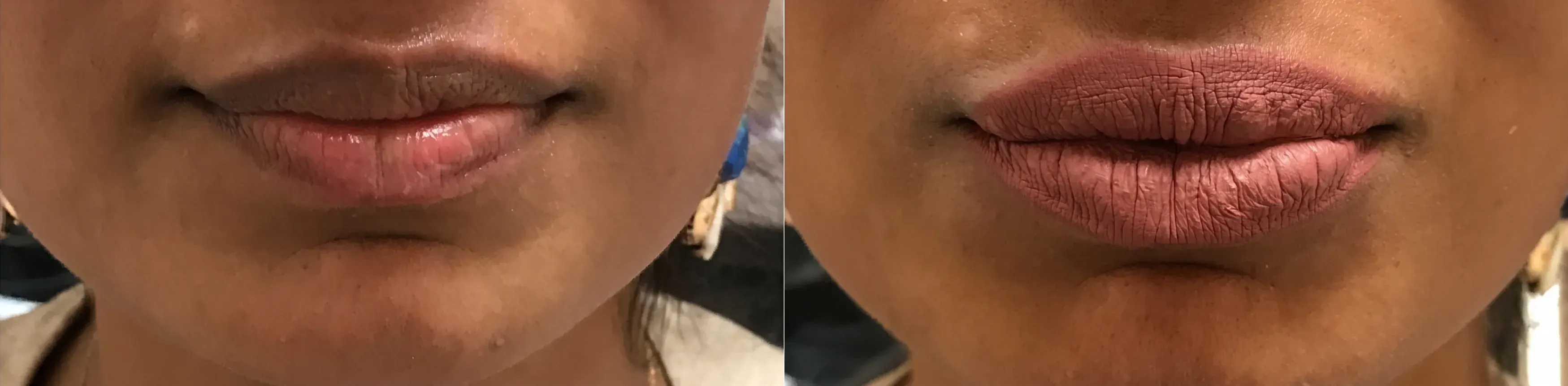 Before and after dermal filler treatment result 6 at Healthy Enhancements in Wellington, FL