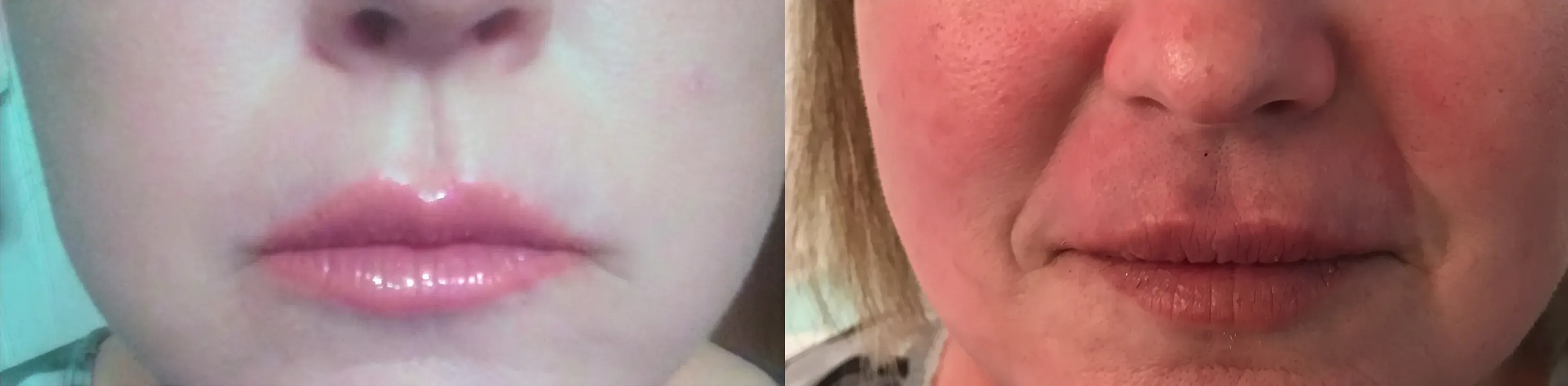 Before and after dermal filler treatment result 7 at Healthy Enhancements in Wellington, FL