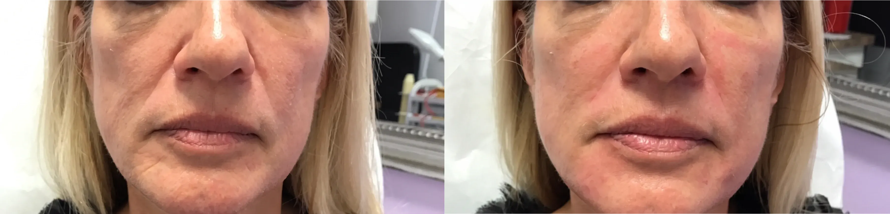 Before and after dermal filler treatment result 8 at Healthy Enhancements in Wellington, FL