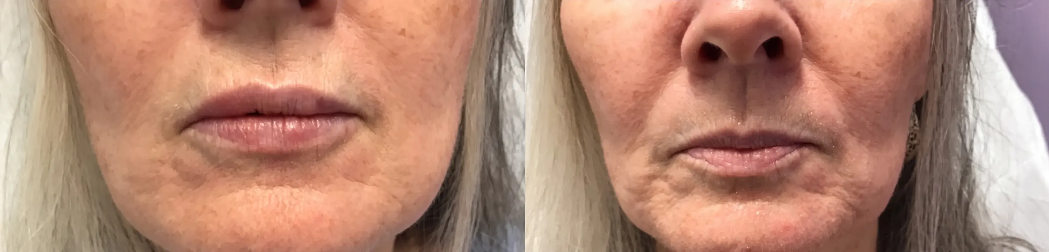 Before and after dermal filler treatment result 9 at Healthy Enhancements in Wellington, FL