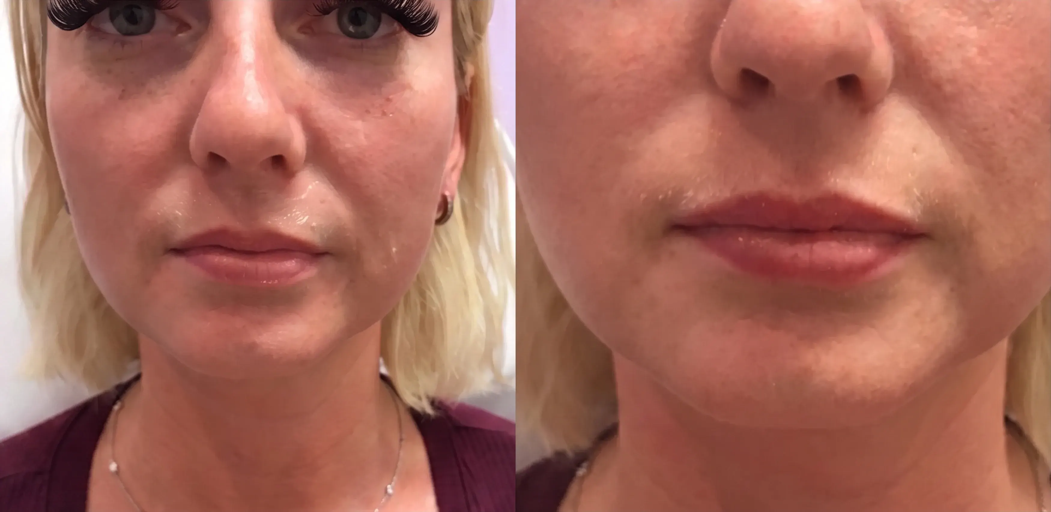 Before and after dermal filler treatment result 10 at Healthy Enhancements in Wellington, FL