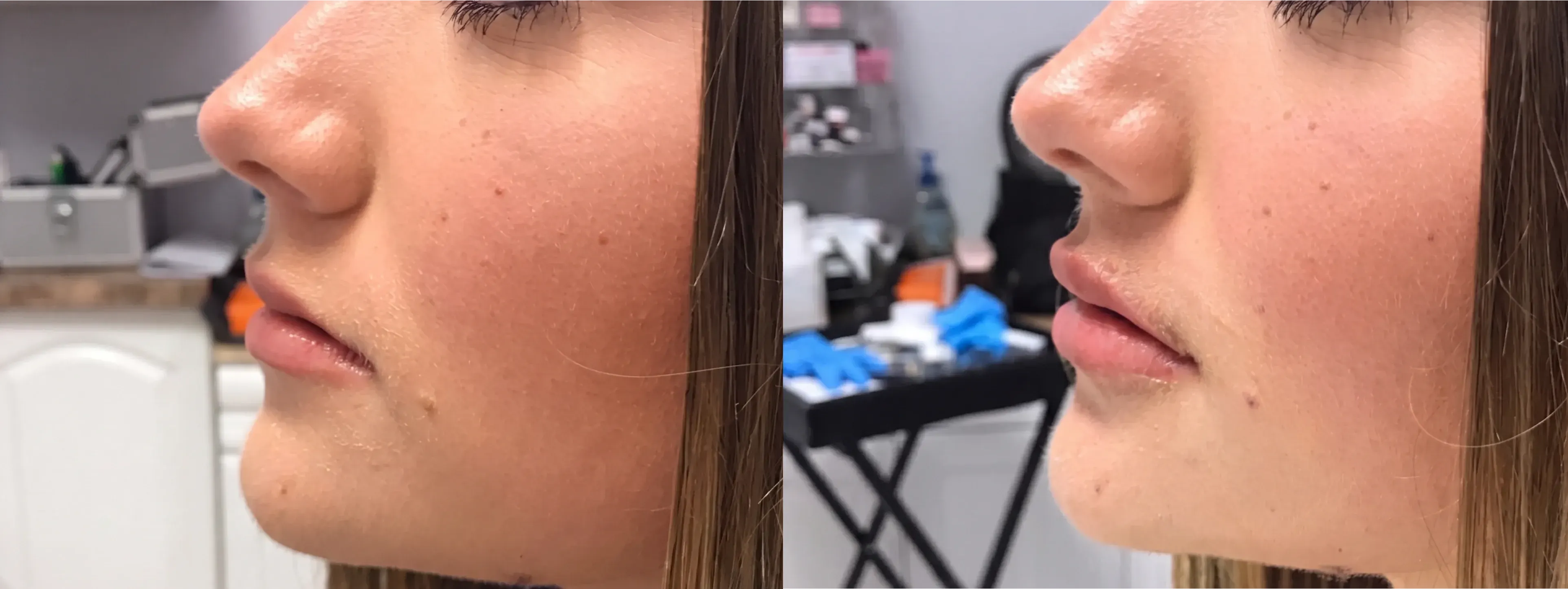 Before and after dermal filler treatment result 11 at Healthy Enhancements in Wellington, FL