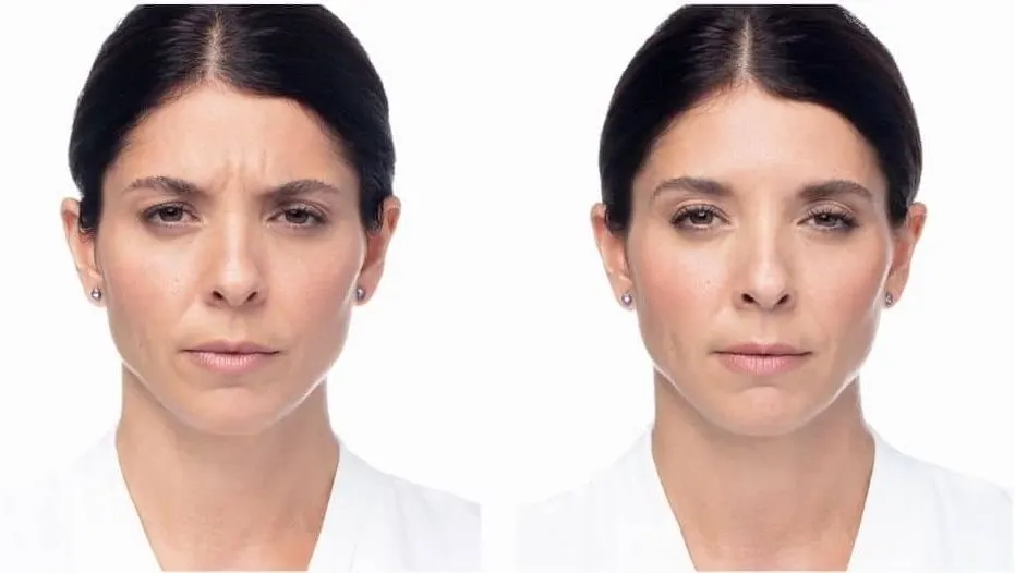 Before and after neurotoxin treatment result 3 at Healthy Enhancements in Wellington, FL