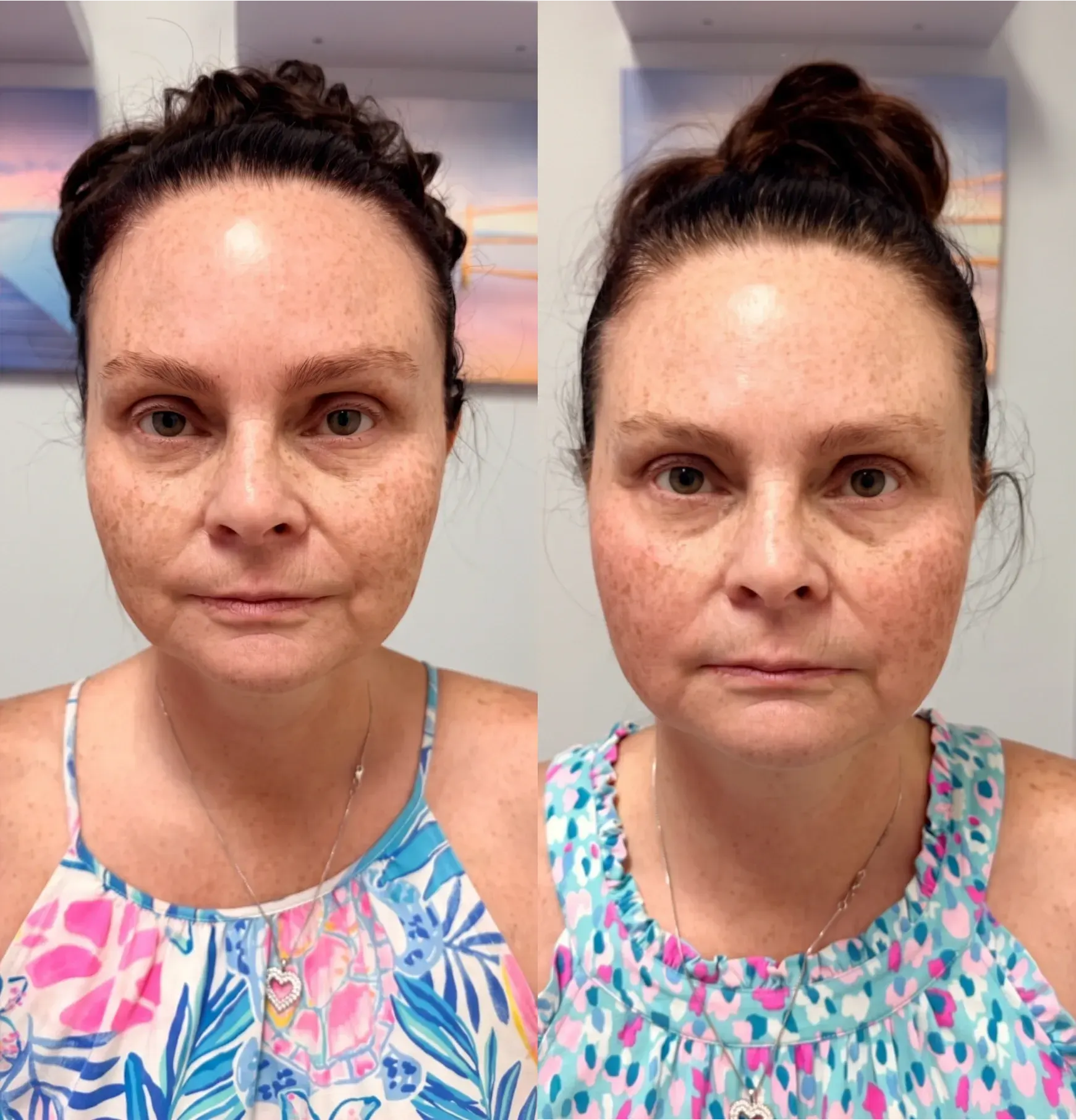 Before and after Emface treatment result 3 at Healthy Enhancements in Wellington, FL