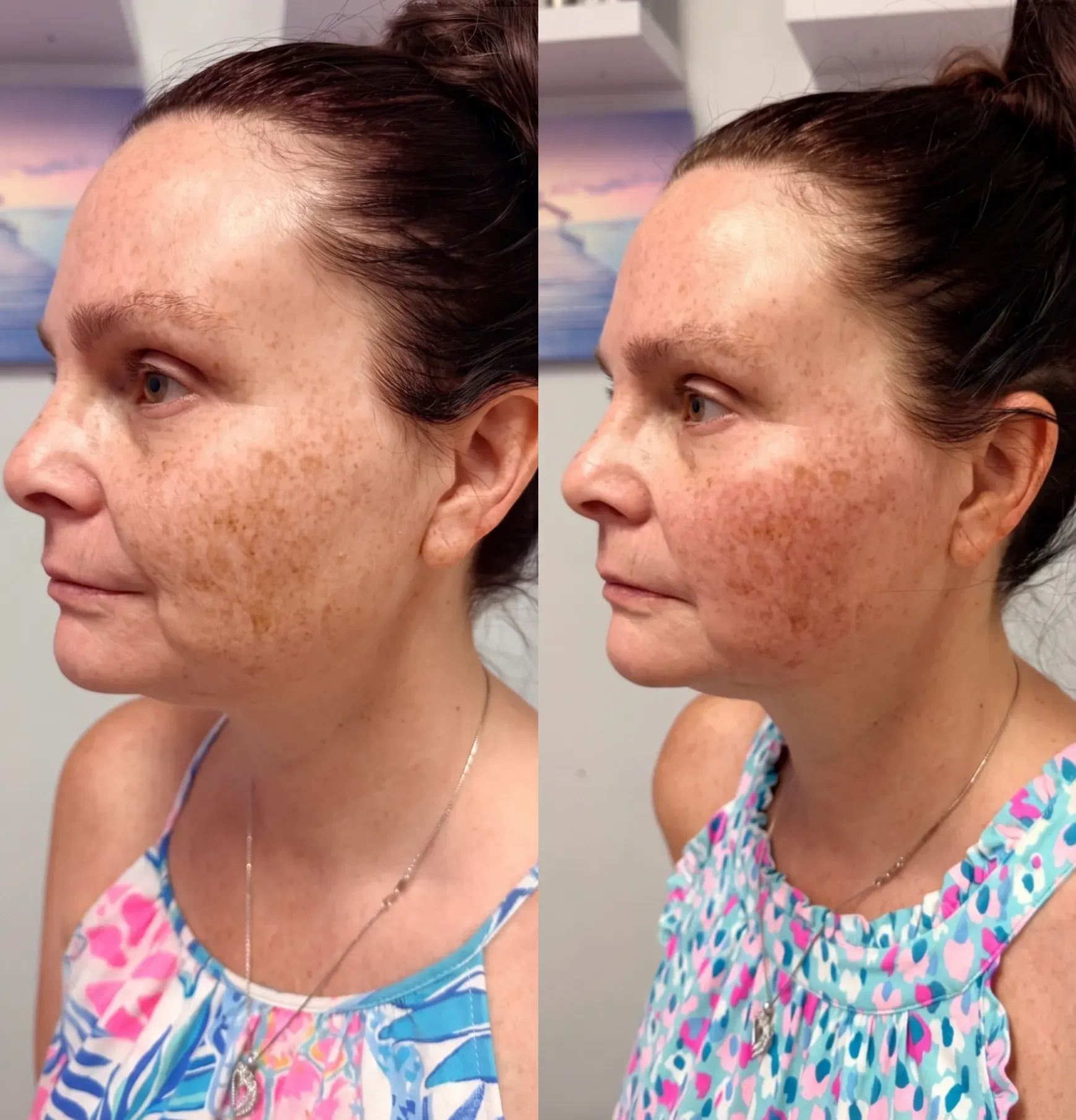Before and after Emface treatment result 4 at Healthy Enhancements in Wellington, FL