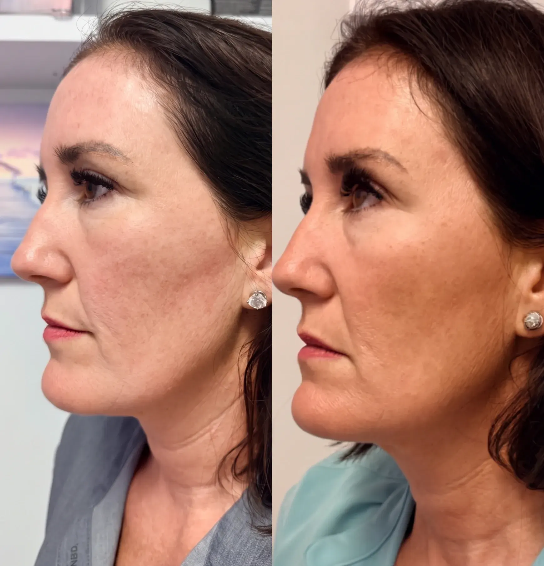 Before and after Emface treatment result 5 at Healthy Enhancements in Wellington, FL