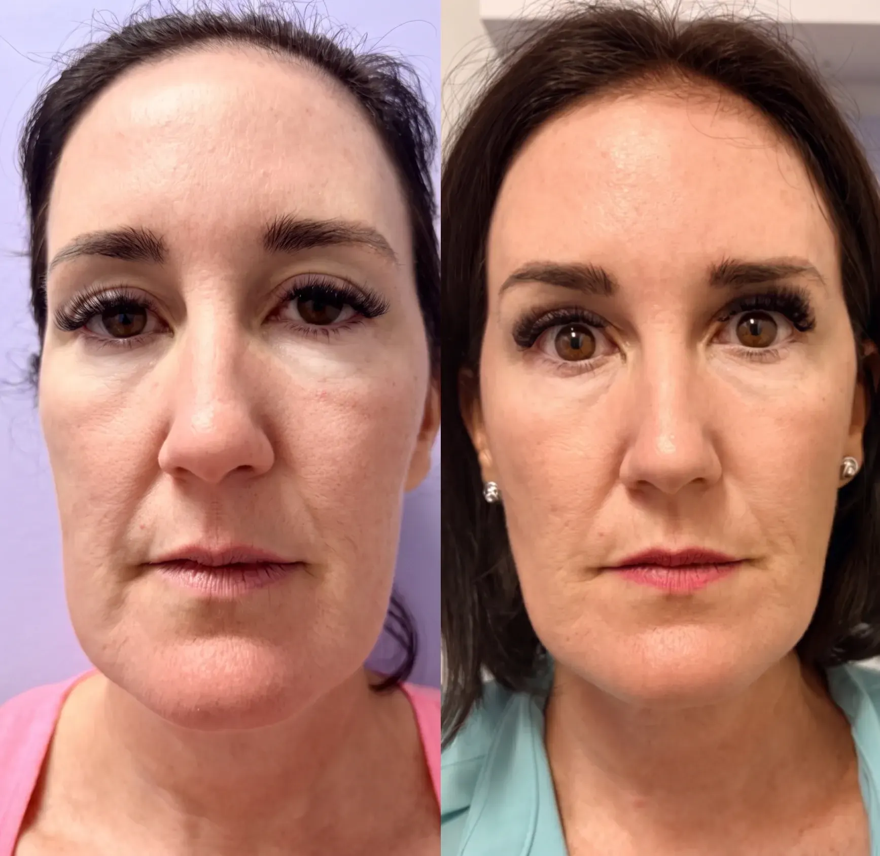 Before and after Emface treatment result 6 at Healthy Enhancements in Wellington, FL