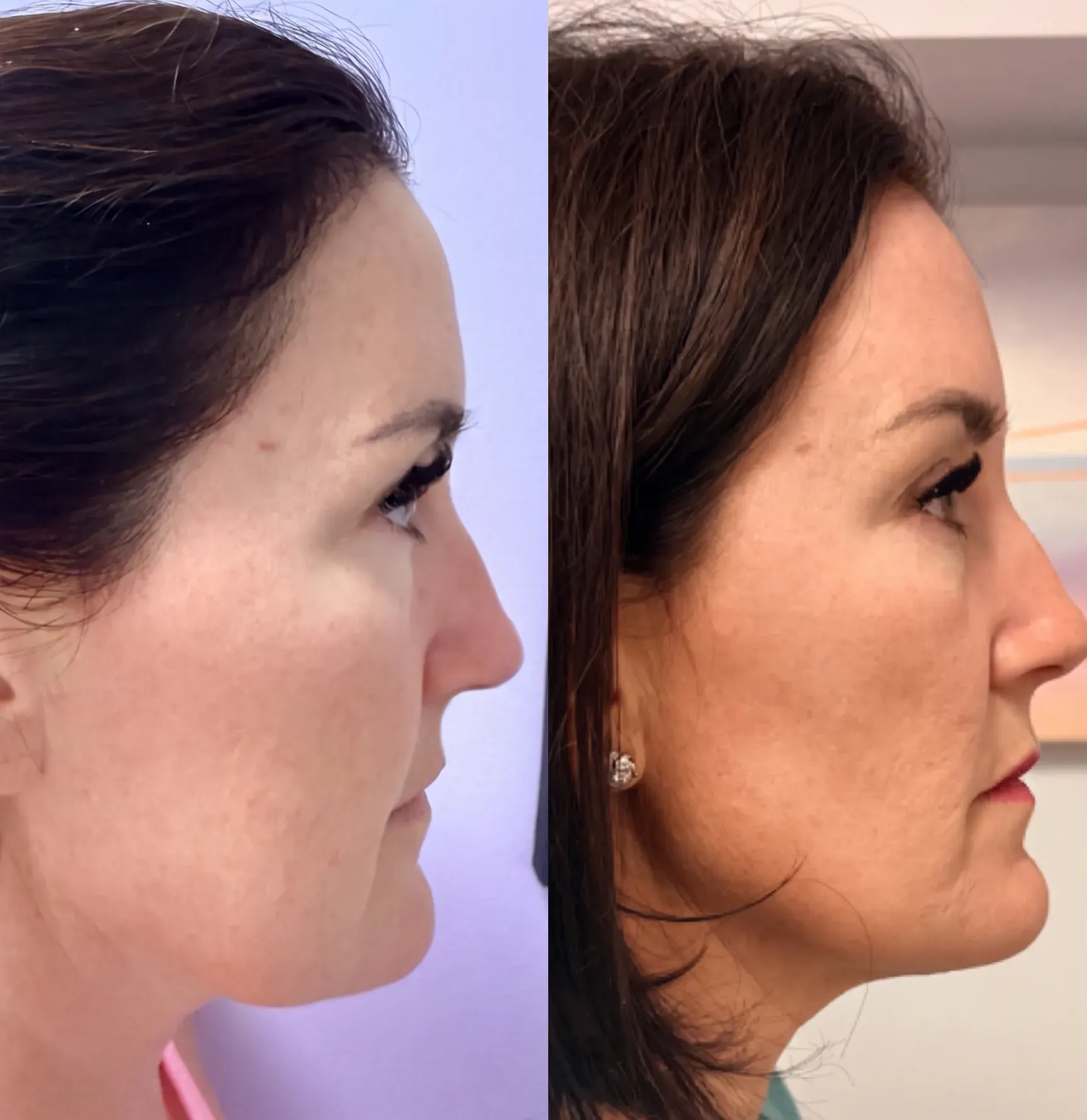 Before and after Emface treatment result 7 at Healthy Enhancements in Wellington, FL