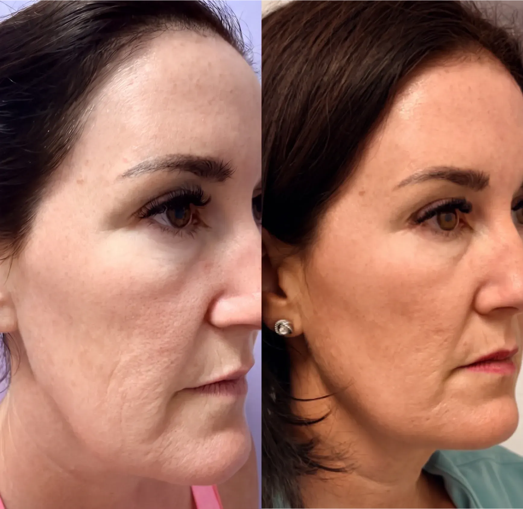Before and after Emface treatment result 8 at Healthy Enhancements in Wellington, FL