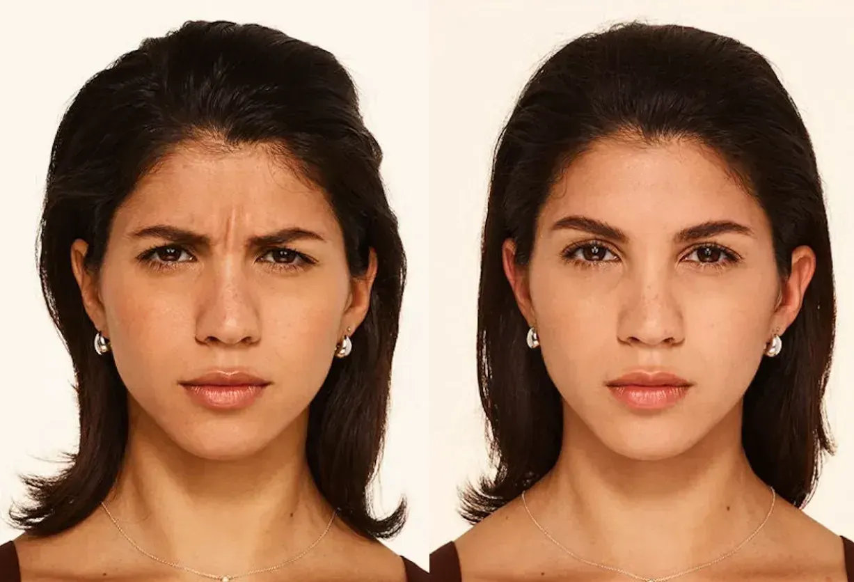 Before and after neurotoxin treatment result 1 at Healthy Enhancements in Wellington, FL