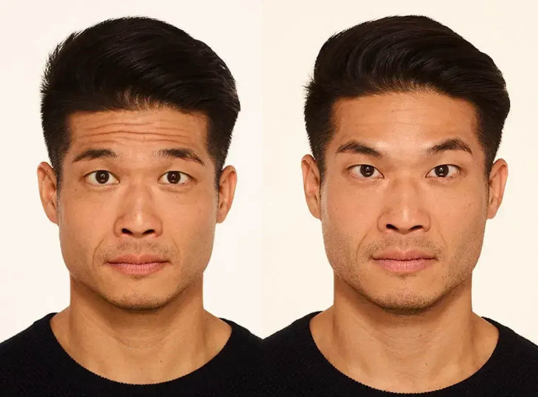 Before and after neurotoxin treatment result 2 at Healthy Enhancements in Wellington, FL