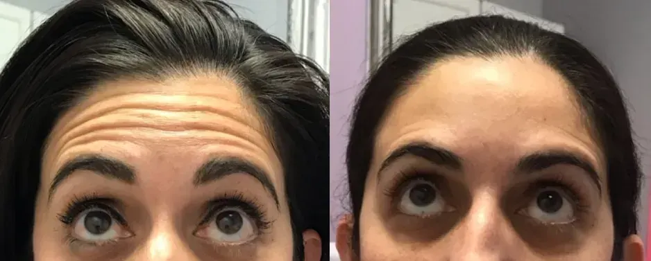 Before and after neurotoxin treatment result 7 at Healthy Enhancements in Wellington, FL
