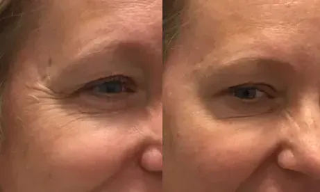 Before and after neurotoxin treatment result 9 at Healthy Enhancements in Wellington, FL