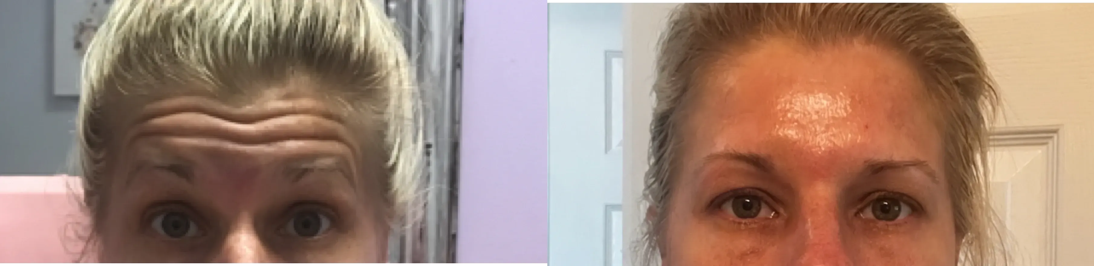 Before and after neurotoxin treatment result 19 at Healthy Enhancements in Wellington, FL