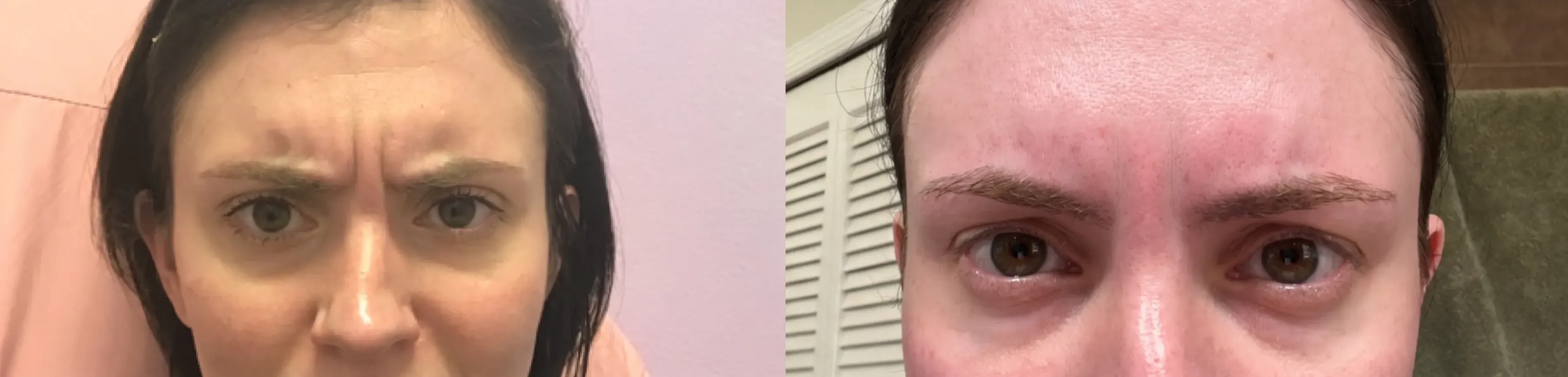 Before and after neurotoxin treatment result 20 at Healthy Enhancements in Wellington, FL