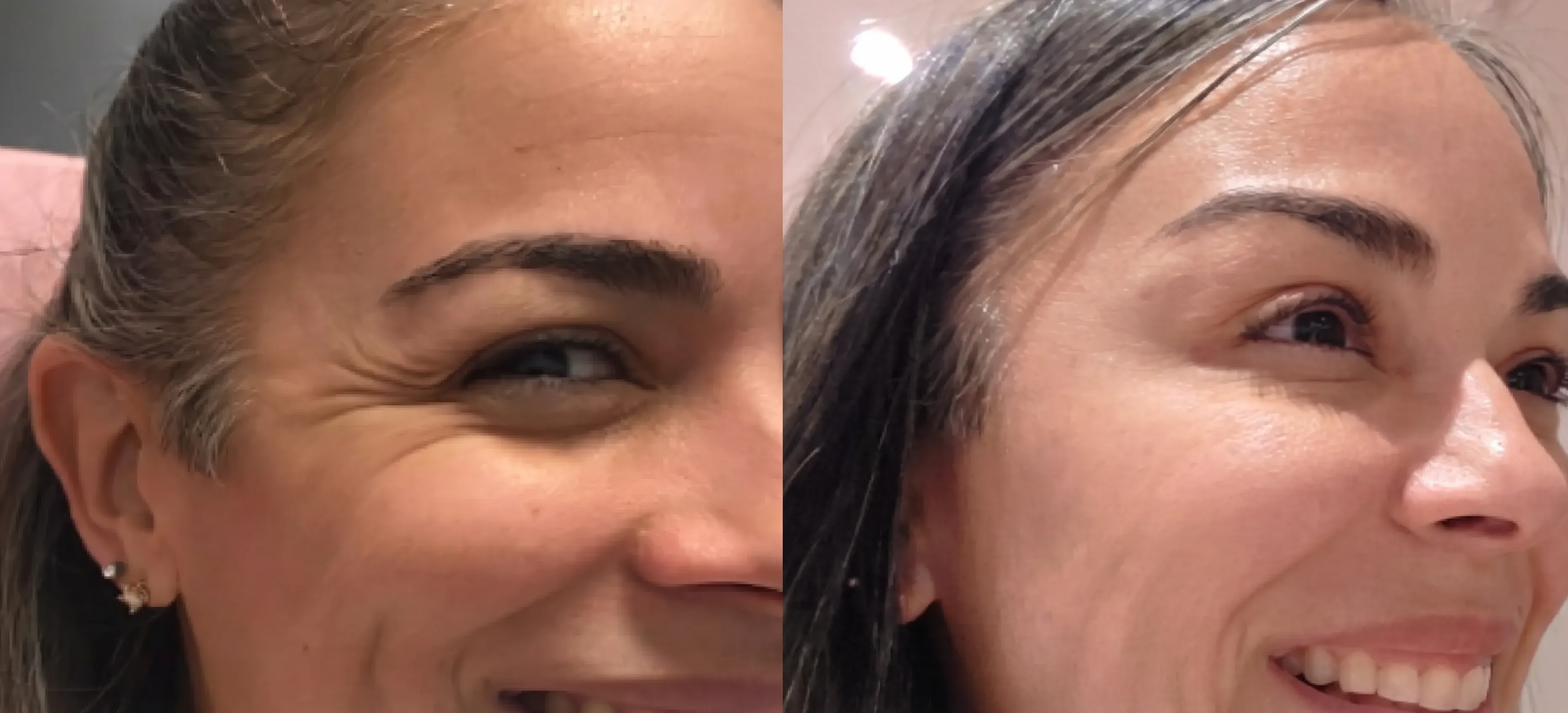 Before and after neurotoxin treatment result 21 at Healthy Enhancements in Wellington, FL