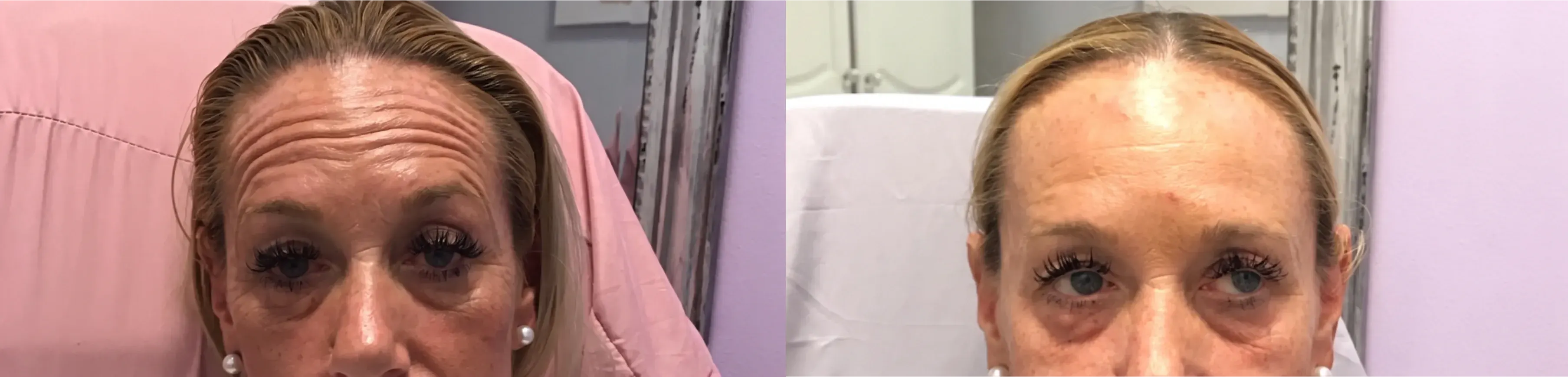 Before and after neurotoxin treatment result 10 at Healthy Enhancements in Wellington, FL