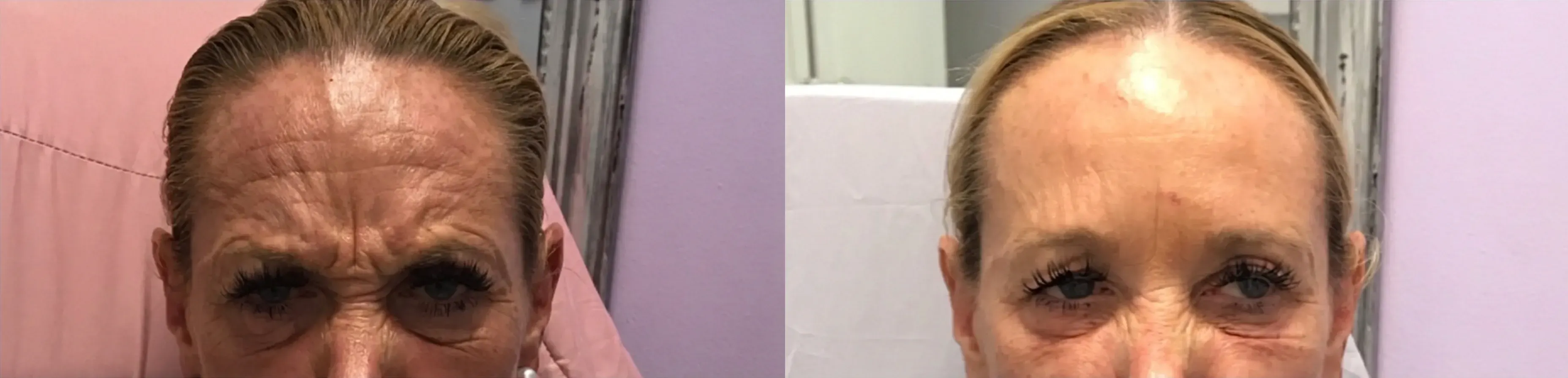 Before and after neurotoxin treatment result 11 at Healthy Enhancements in Wellington, FL
