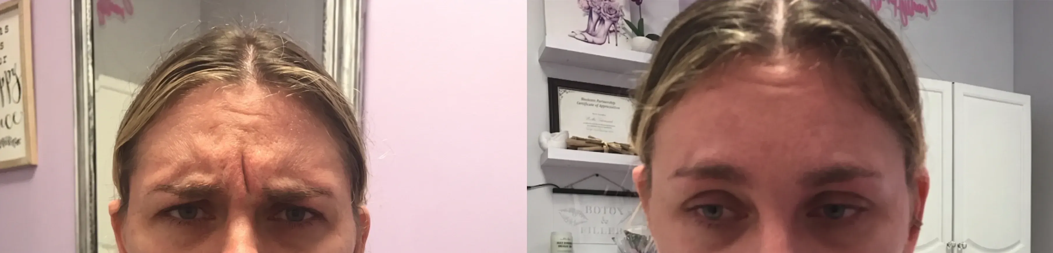 Before and after neurotoxin treatment result 12 at Healthy Enhancements in Wellington, FL
