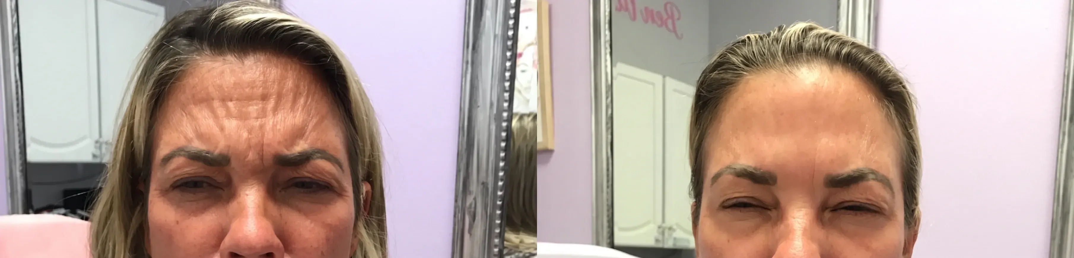 Before and after neurotoxin treatment result 13 at Healthy Enhancements in Wellington, FL