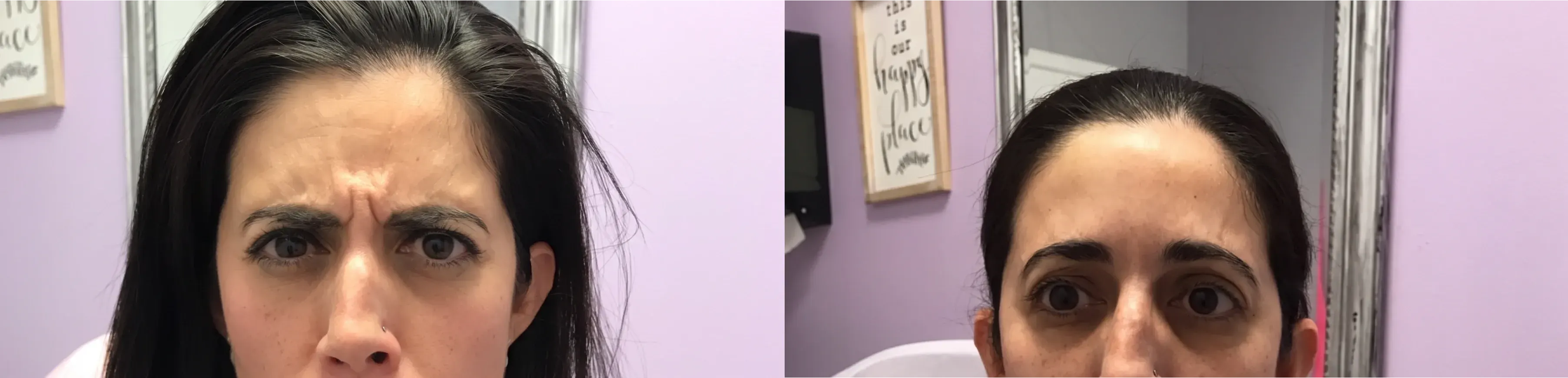 Before and after neurotoxin treatment result 14 at Healthy Enhancements in Wellington, FL