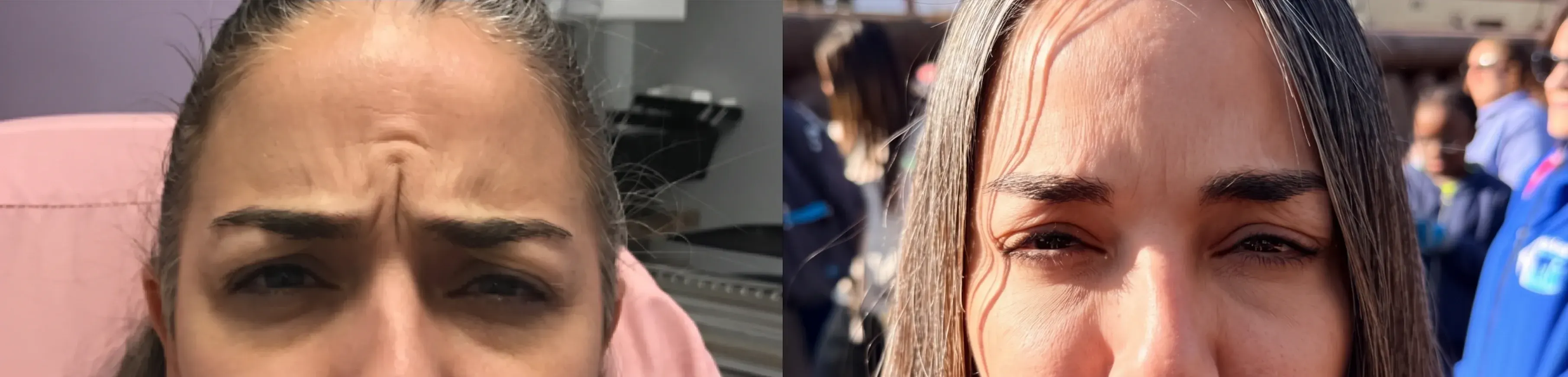 Before and after neurotoxin treatment result 15 at Healthy Enhancements in Wellington, FL