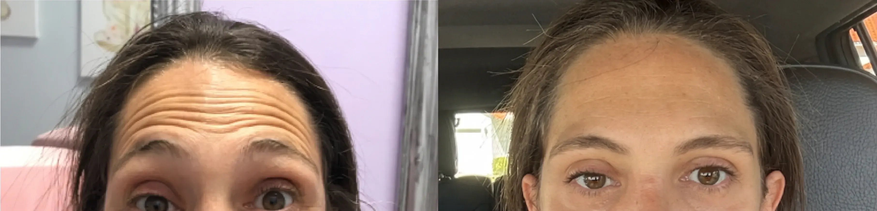Before and after neurotoxin treatment result 16 at Healthy Enhancements in Wellington, FL