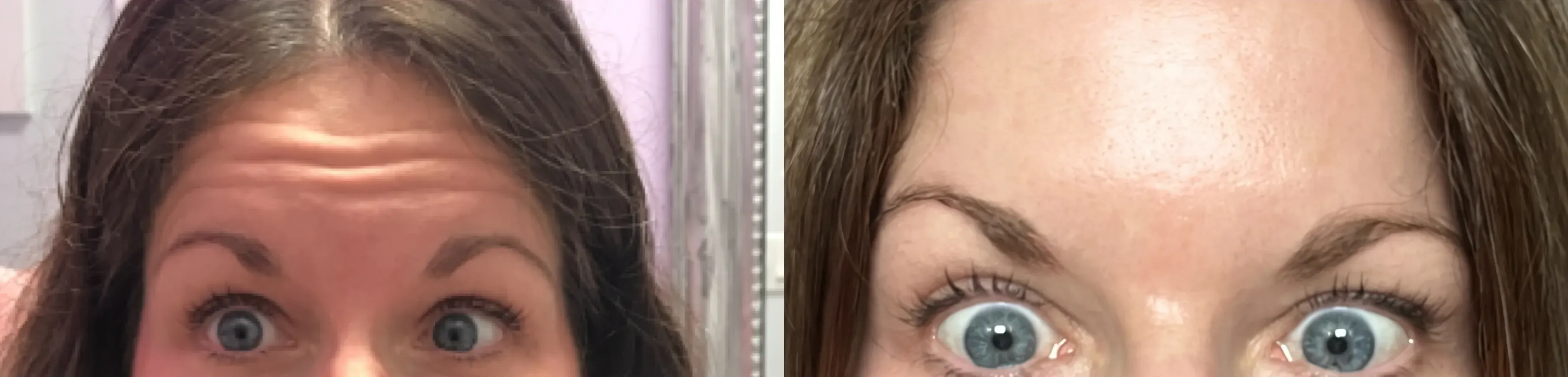 Before and after neurotoxin treatment result 17 at Healthy Enhancements in Wellington, FL