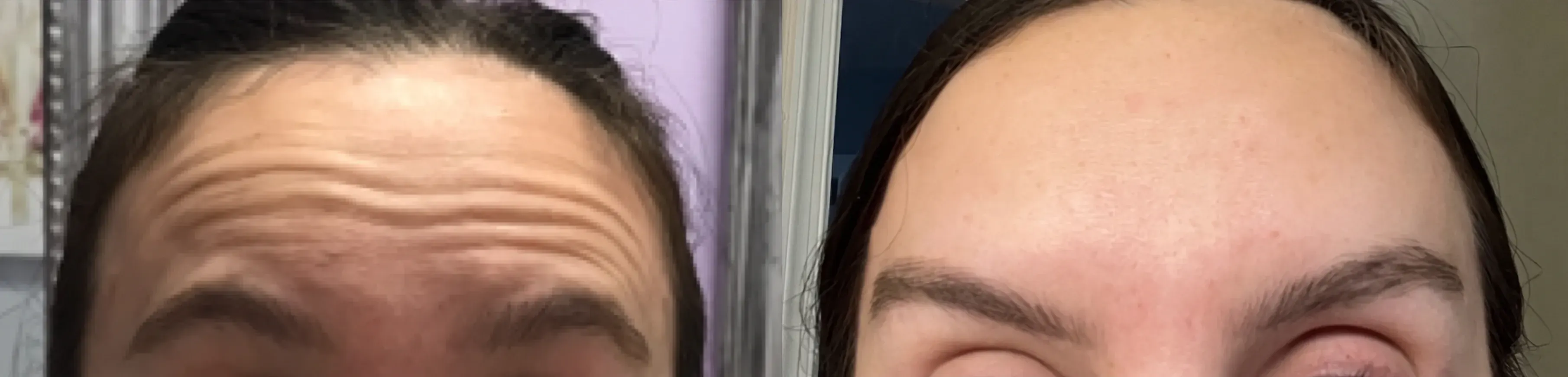 Before and after neurotoxin treatment result 18 at Healthy Enhancements in Wellington, FL