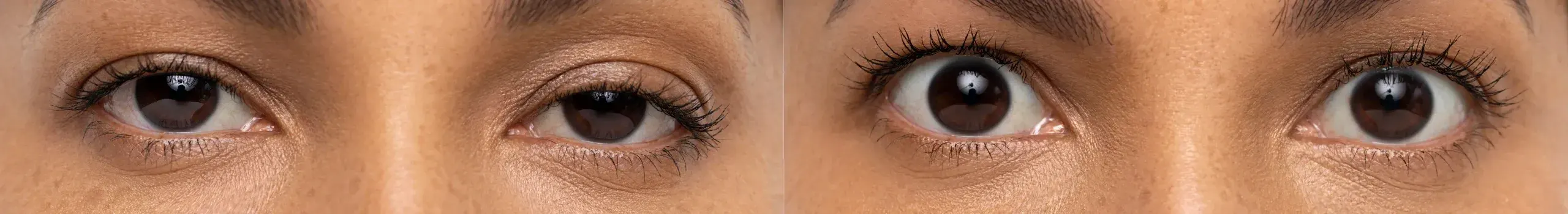 Before and after Upneeq treatment result at Healthy Enhancements in Wellington, FL