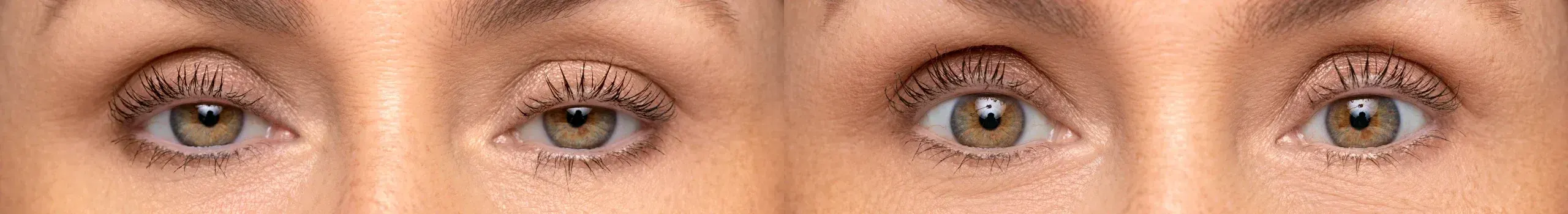 Before and after Upneeq treatment result 2 at Healthy Enhancements in Wellington, FL
