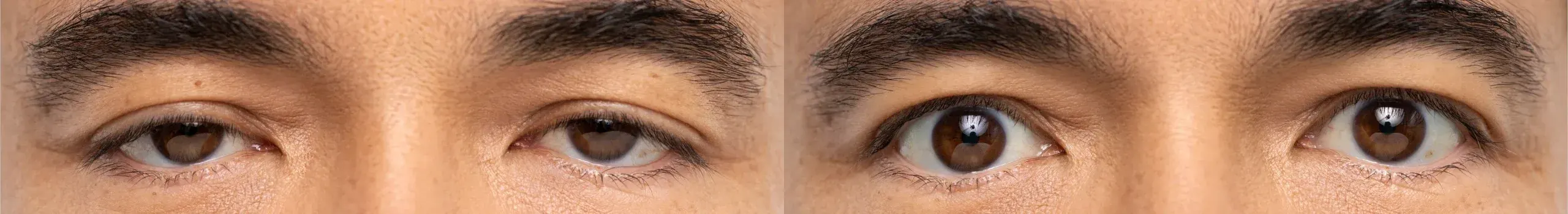 Before and after Upneeq treatment result 3 at Healthy Enhancements in Wellington, FL