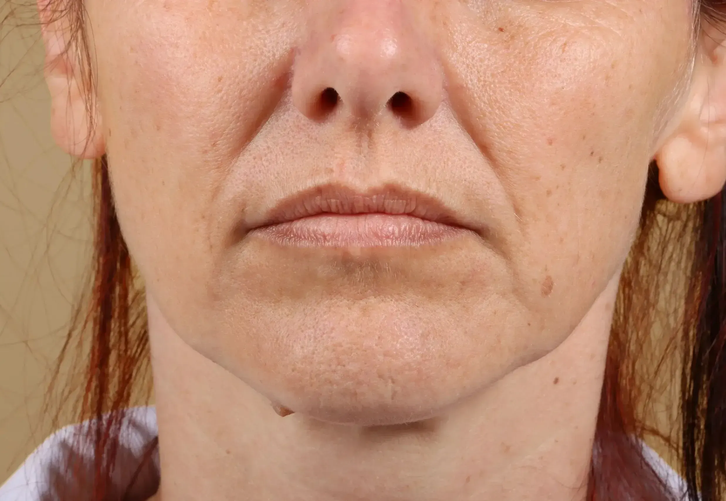 Close-up illustrating nasolabial smile lines at Healthy Enhancements Wellington