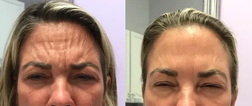 Before and after neurotoxin treatment result 8 at Healthy Enhancements in Wellington, FL