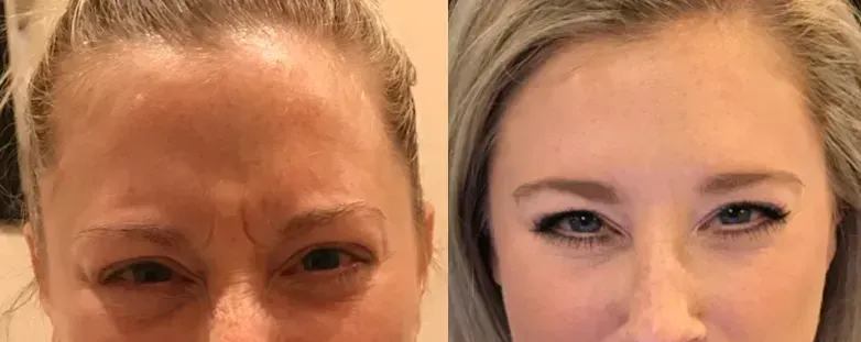 Before and after neurotoxin treatment result 6 at Healthy Enhancements in Wellington, FL
